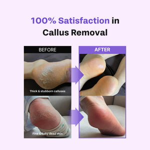 Callus Remover Kit for Feet - Foot File & Peeling Foot Spray